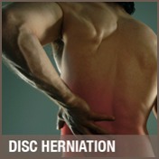 Disc Herniation Treatment, Chiropractor Co. Antrim